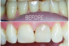 KDC-FA-Teeth-Whitening