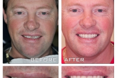 CEREC before and after.

Healthy smile, healthy life.