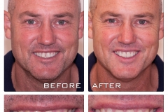 CEREC before and after.
Better smile brings better confidence