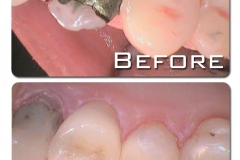 CEREC crown and a CEREC onlay constructed to protect heavily filled teeth