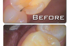 CEREC crown made to protect a symptomatic cracked tooth from splitting