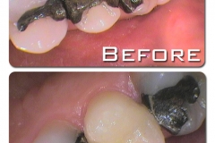 Replacement of amalgam filled, cracked tooth, with a CEREC crown (one visit)