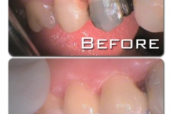 Kaleen-Dental-Care-CEREC-before-after-111024