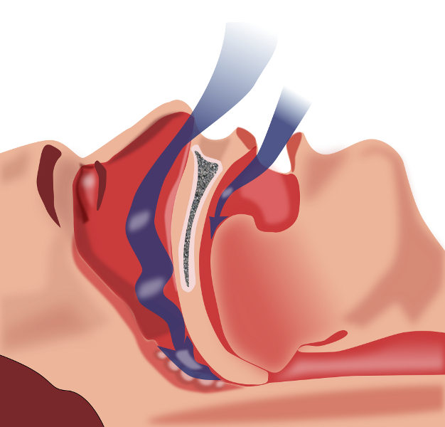 Obstructive Sleep Apnea (OSA)