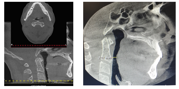 Sleep Apnoea Treatment by NightLase® - Airways dimensions Before and After